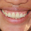 dent